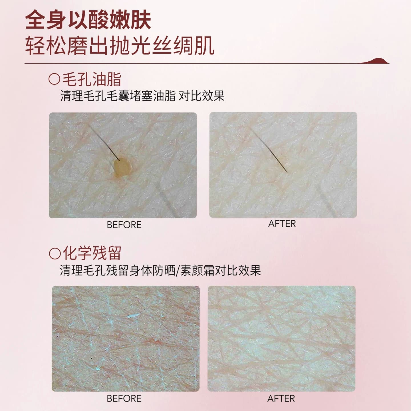 净背磨砂｜SD淳存2%复合乳酸磨砂膏水杨酸氨基酸前胸后背痘奶霜 - 缩略图5
