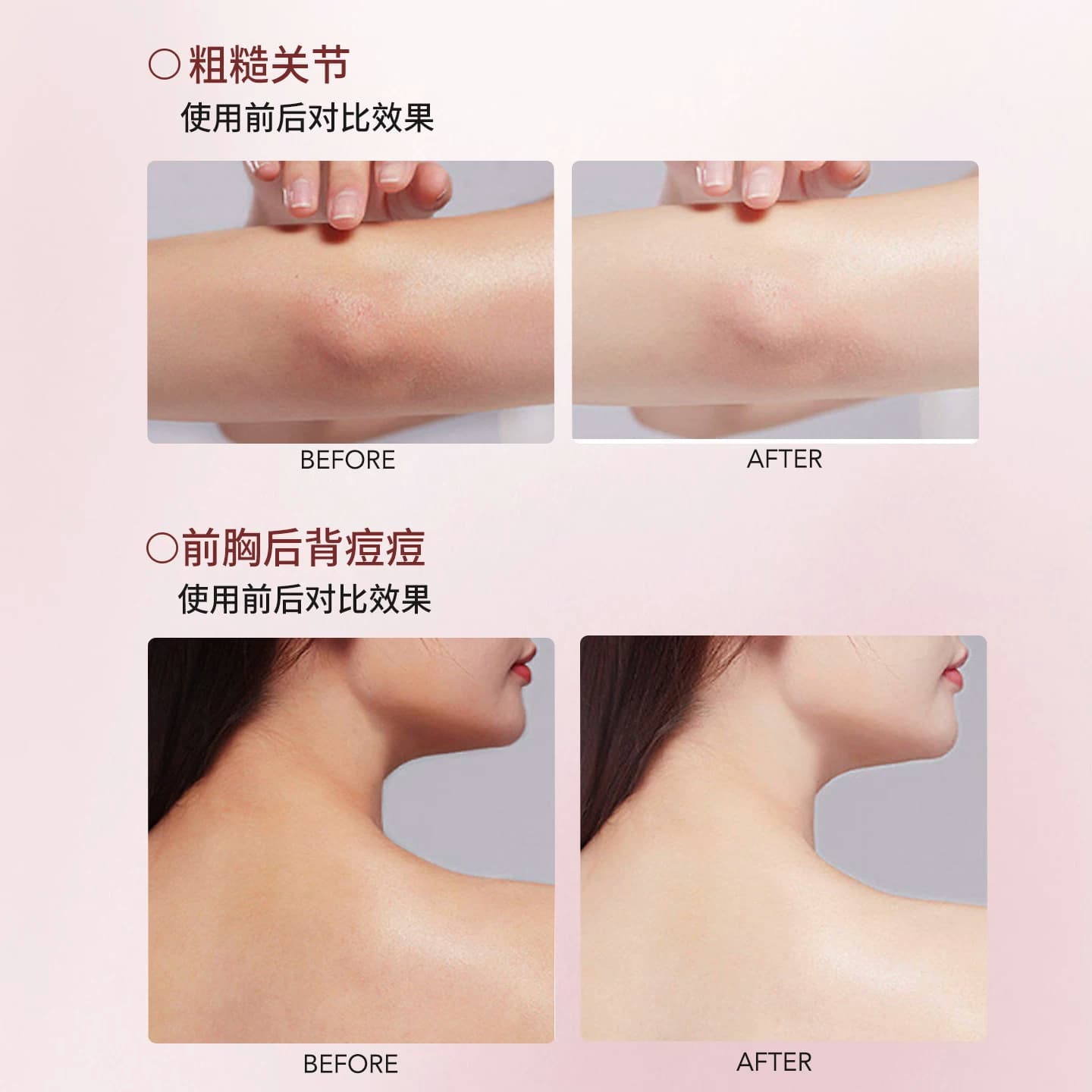 次抛棉片｜SD淳存2%复合乳酸净背美肤棉片水杨酸牛奶刷酸背痘消 - 缩略图3
