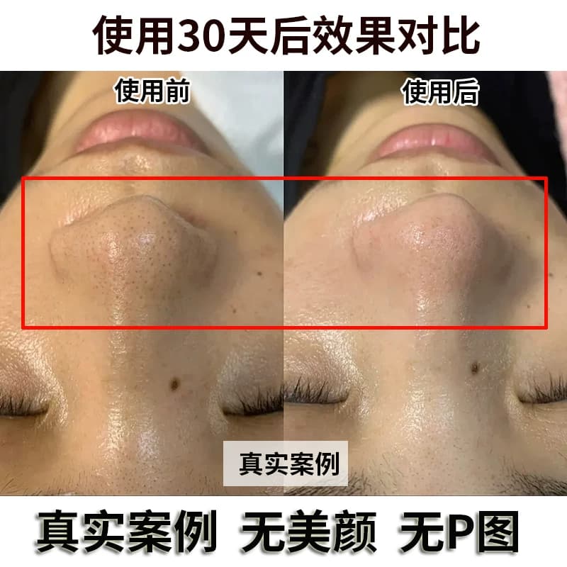 韩纪茶树去黑头套盒官方正品收毛孔深层清洁院线大牌专用TK - 缩略图2