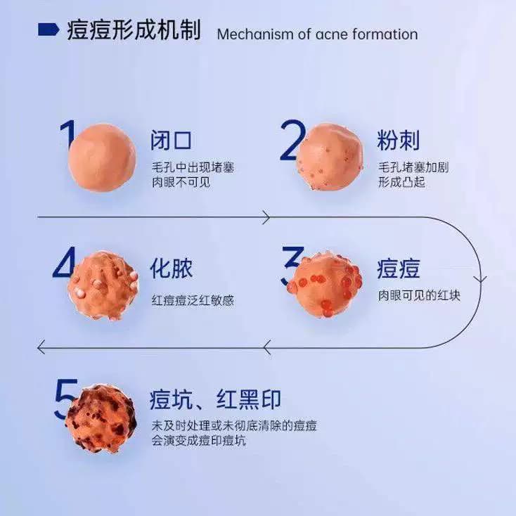 云南本草痘印淡化消青春学生粉刺养护闭口控油痘坑舒缓 - 缩略图2