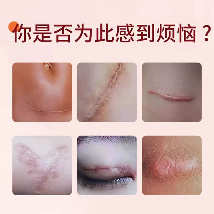 诺瑞达疤痕修复剂10g/支SZ - 缩略图2