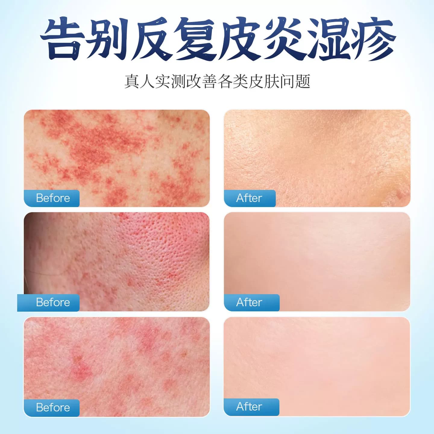 朕医生诺瑞达皮肤敷料适用于皮炎湿疹青春痘脱皮红斑瘙痒痤疮sz - 缩略图2
