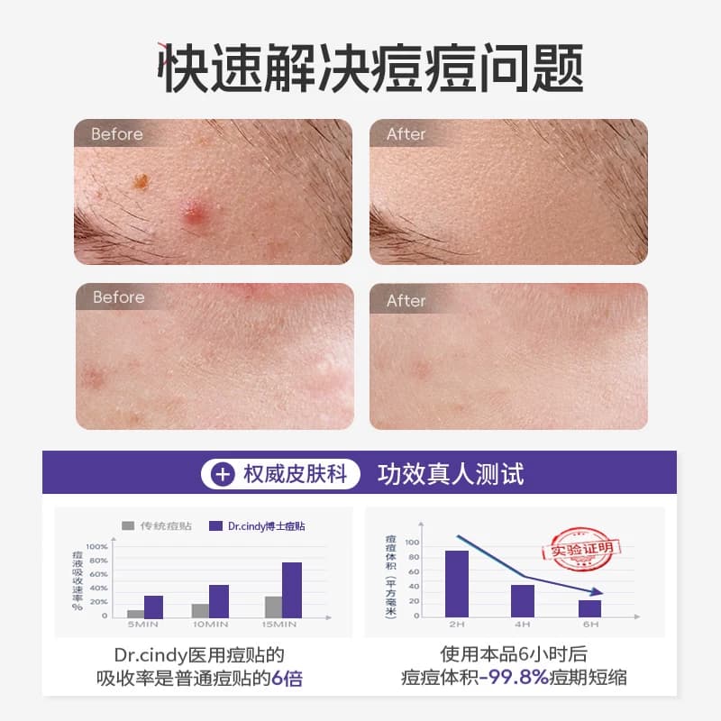 医用痘痘贴吸脓净痘日夜两用隔绝污染上妆隐形遮瑕水胶体敷料械字 - 缩略图4
