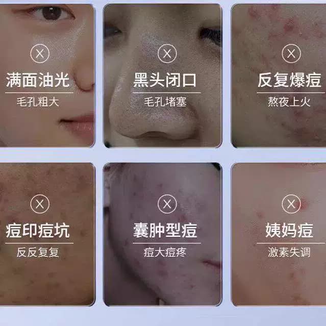云南本草痘印淡化消青春学生粉刺养护闭口控油痘坑舒缓 - 缩略图4
