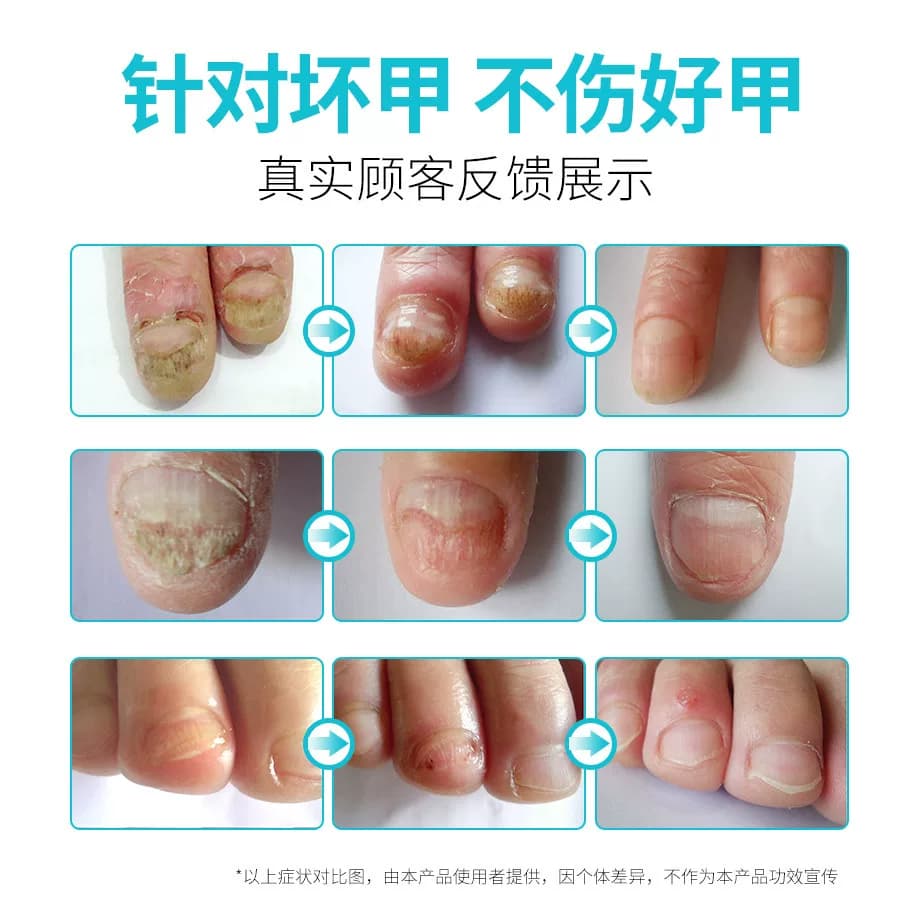 脚医生正品甲卫士灰指甲专用甲沟旗舰店修甲修脚刀冰醋酸剪指刀炎 - 缩略图2