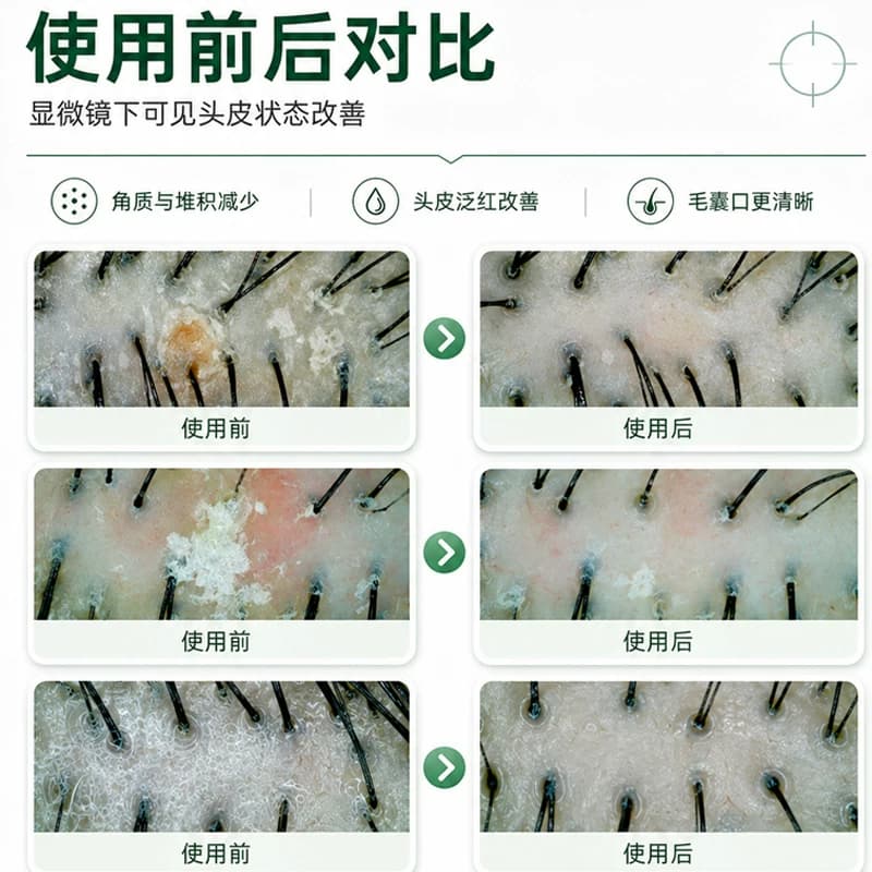 【雍禾植发】史云逊净爽舒缓头皮素青蒿预洗素控油舒缓温和不刺激 - 缩略图5