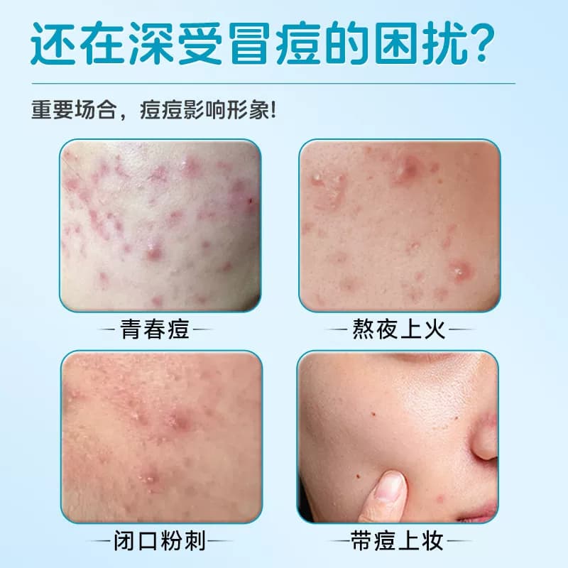 医用星星痘痘贴修复炎印贴人工皮水胶体敷料吸液贴可上妆遮瑕正品 - 缩略图3